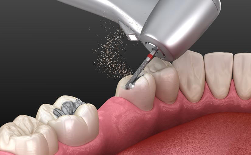 eliminacion de caries